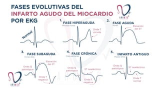 Infarto Agudo al miocardio con elevación ST | PPTX