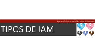 TIPOS DE IAM
Cuarta definición universal del infarto de miocardio
 