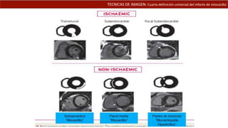 TECNICAS DE IMAGEN: Cuarta definición universal del infarto de miocardio
 