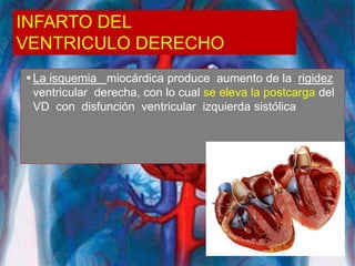 INFARTO DEL
VENTRICULO DERECHO
La isquemia miocárdica produce aumento de la rigidez
ventricular derecha, con lo cual se eleva la postcarga del
VD con disfunción ventricular izquierda sistólica
 