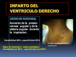 Sensibilidad 88% ,especificidad 69%
Signo de kussmaul + pulso paradojico
Sensibilidad de 88% , especificidad de 100%
Presion de llenado VD en
inspiracion
 