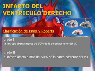 Clasificación de Isner y Roberts
grado I
la necrosis abarca menos del 50% de la pared posterior del VD
grado II
el infarto afecta a más del 50% de la pared posterior del VD
INFARTO DEL
VENTRICULO DERECHO
 
