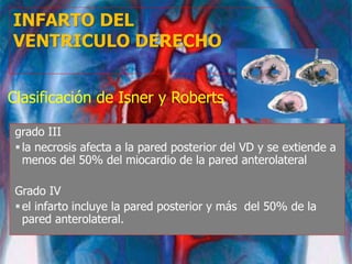 INFARTO DEL
VENTRICULO DERECHO
grado III
la necrosis afecta a la pared posterior del VD y se extiende a
menos del 50% del miocardio de la pared anterolateral
Grado IV
el infarto incluye la pared posterior y más del 50% de la
pared anterolateral.
Clasificación de Isner y Roberts
 