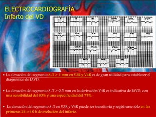 ELECTROCARDIOGRAFÍA
Infarto del VD
 La elevación del segmento S-T > 1 mm en V3R y V4R es de gran utilidad para establecer el
diagnóstico de IAVD.
 La elevación del segmento S-T > 0,5 mm en la derivación V4R es indicativa de IAVD, con
una sensibilidad del 83% y una especificidad del 77%.
 La elevación del segmento S-T en V3R y V4R puede ser transitoria y registrarse sólo en las
primeras 24 o 48 h de evolución del infarto.
 