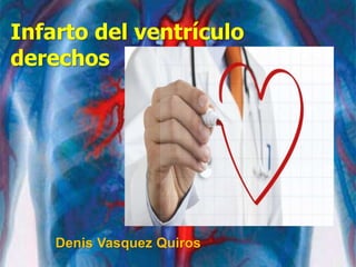 Infarto del ventrículo
derechos
Denis Vasquez Quiros
 