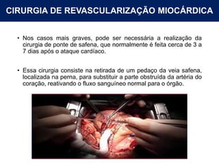 CIRURGIA DE REVASCULARIZAÇÃO MIOCÁRDICA
• Nos casos mais graves, pode ser necessária a realização da
cirurgia de ponte de safena, que normalmente é feita cerca de 3 a
7 dias após o ataque cardíaco.
• Essa cirurgia consiste na retirada de um pedaço da veia safena,
localizada na perna, para substituir a parte obstruída da artéria do
coração, reativando o fluxo sanguíneo normal para o órgão.
 