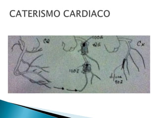 Infarto Agudo de Miocardio Inferior