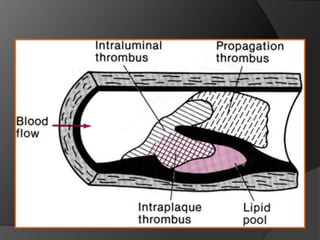 Daño en la Cápsula dePLACA VULNERABLE (mecánico, inflamatorio) Contacto de factor tisular con la sangreGran daño en la cápsula o factores trombogenicosCapa de plaquetas, mínimo tromboTROMBO MURAL O LABIL. Isquemia. Gran crecimiento de la placa, TROMBO OCLUSIVOPlaquetas+ trombina+fibrinay hematiesProgresión de la lesionREPARACION (cicatrización)  o PLACA ESTABLEPosible isquemia continuada. Puede seguir vulnerable, Puede embolizar