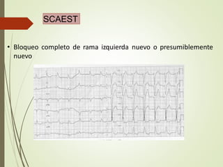 SCAEST
• Bloqueo completo de rama izquierda nuevo o presumiblemente
nuevo
 