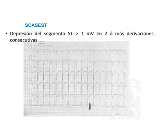 SCASEST
• Depresión del segmento ST
consecutivas
> 1 mV en 2 ó más derivaciones
 
