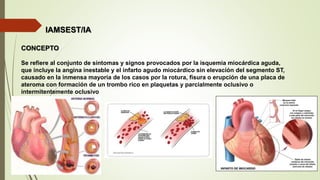 IAMSEST/IA
CONCEPTO
Se refiere al conjunto de síntomas y signos provocados por la isquemia miocárdica aguda,
que incluye la angina inestable y el infarto agudo miocárdico sin elevación del segmento ST,
causado en la inmensa mayoría de los casos por la rotura, fisura o erupción de una placa de
ateroma con formación de un trombo rico en plaquetas y parcialmente oclusivo o
intermitentemente oclusivo
 