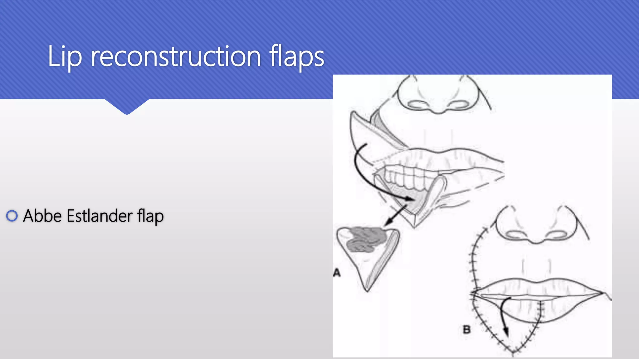 Grafts and flaps in head and neck | PPTX