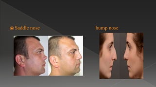 ⦿ Saddle nose hump nose
 
