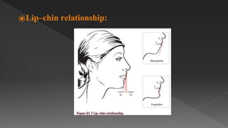 ⦿Lip–chin relationship:
 