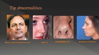 Tip abnormalities
BROAD ,BULLOUS,SQUARE BALL TIP BIFID TIP UPWARDLY ROTATED TIP
ASYMMETRIC TIP
 