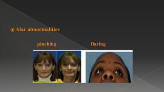 ⦿ Alar abnormalities
pinching flaring
 