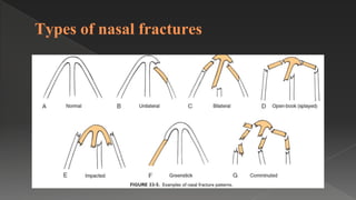 Types of nasal fractures
 