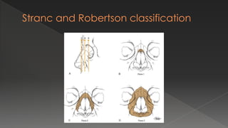 Stranc and Robertson classification
 