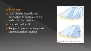 ⦿ Treatment
⦿ LLC divided laterally and
overlapped to deprojected tip
and create tip rotation.
⦿ Lateral crural steal
⦿ Tongue in groove technique of
septocolumellar suturing
 