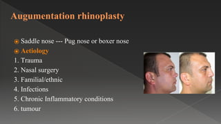 Augumentation rhinoplasty
⦿ Saddle nose --- Pug nose or boxer nose
⦿ Aetiology
1. Trauma
2. Nasal surgery
3. Familial/ethnic
4. Infections
5. Chronic Inflammatory conditions
6. tumour
 