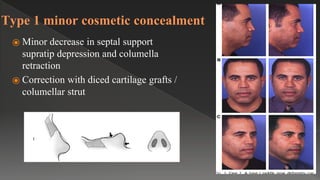 Type 1 minor cosmetic concealment
⦿ Minor decrease in septal support
supratip depression and columella
retraction
⦿ Correction with diced cartilage grafts /
columellar strut
 