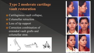 Type 2 moderate cartilage
vault restoration
⦿ Cartilaginous vault collapse,
⦿ Columellar retraction
⦿ Loss of tip support
⦿ Correction combination of
extended vault grafts and
columellar strut.
 