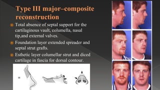 Type III major–composite
reconstruction
⦿ Total absence of septal support for the
cartilaginous vault, columella, nasal
tip,and external valves.
⦿ Foundation layer extended spreader and
septal strut grafts.
⦿ Esthetic layer columellar strut and diced
cartilage in fascia for dorsal contour.
 