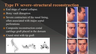 Type IV severe–structural reconstruction
⦿ End stage of septal collapse.
⦿ Bony vault disruption
⦿ Severe contracture of the nasal lining,
often associated with major septal
perforations
⦿ Composite reconstruction costal
cartilage graft placed in the dorsum
⦿ Crural strut with tip graft
 