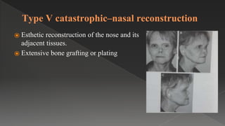 Type V catastrophic–nasal reconstruction
⦿ Esthetic reconstruction of the nose and its
adjacent tissues.
⦿ Extensive bone grafting or plating
 