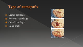 Type of autografts
⦿ Septal cartilage
⦿ Auricular cartilage
⦿ Costal cartilage
⦿ Bone graft
 