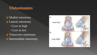 Osteotomies
⦿ Medial osteotomy
⦿ Lateral osteotomy
• Low to high
• Low to low
⦿ Transverse osteotomy
⦿ Intermediate osteotomy
 