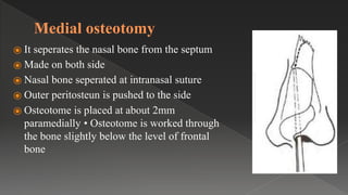 Medial osteotomy
⦿ It seperates the nasal bone from the septum
⦿ Made on both side
⦿ Nasal bone seperated at intranasal suture
⦿ Outer peritosteun is pushed to the side
⦿ Osteotome is placed at about 2mm
paramedially • Osteotome is worked through
the bone slightly below the level of frontal
bone
 