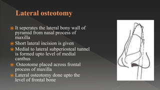 Lateral osteotomy
⦿ It seperates the lateral bony wall of
pyramid from nasal process of
maxilla
⦿ Short lateral incision is given
⦿ Medial to lateral subperiosteal tunnel
is formed upto level of medial
canthus
⦿ Osteotome placed across frontal
process of maxilla
⦿ Lateral osteotomy done upto the
level of frontal bone
 