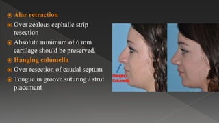 ⦿ Alar retraction
⦿ Over zealous cephalic strip
resection
⦿ Absolute minimum of 6 mm
cartilage should be preserved.
⦿ Hanging columella
⦿ Over resection of caudal septum
⦿ Tongue in groove suturing / strut
placement
 