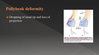 Pollybeak deformity
⦿ Dropping of nasal tip and loss of
projection
 