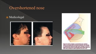 Overshortened nose
⦿ Medicolegal
 