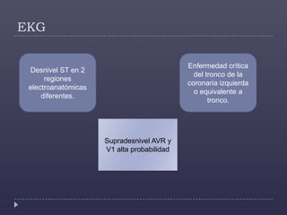 EKGDesnivel ST en 2 regiones electroanatómicas diferentes.Enfermedad crítica del tronco de la coronaria izquierda o equivalente a tronco.SupradesnivelAVR y V1 alta probabilidad 