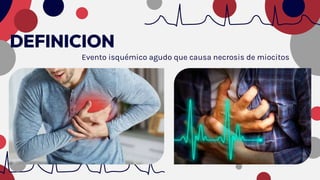 DEFINICION
Evento isquémico agudo que causa necrosis de miocitos