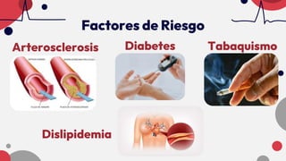 Arterosclerosis Diabetes Tabaquismo
Dislipidemia
Factores de Riesgo