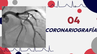 CORONARIOGRAFÍA
04