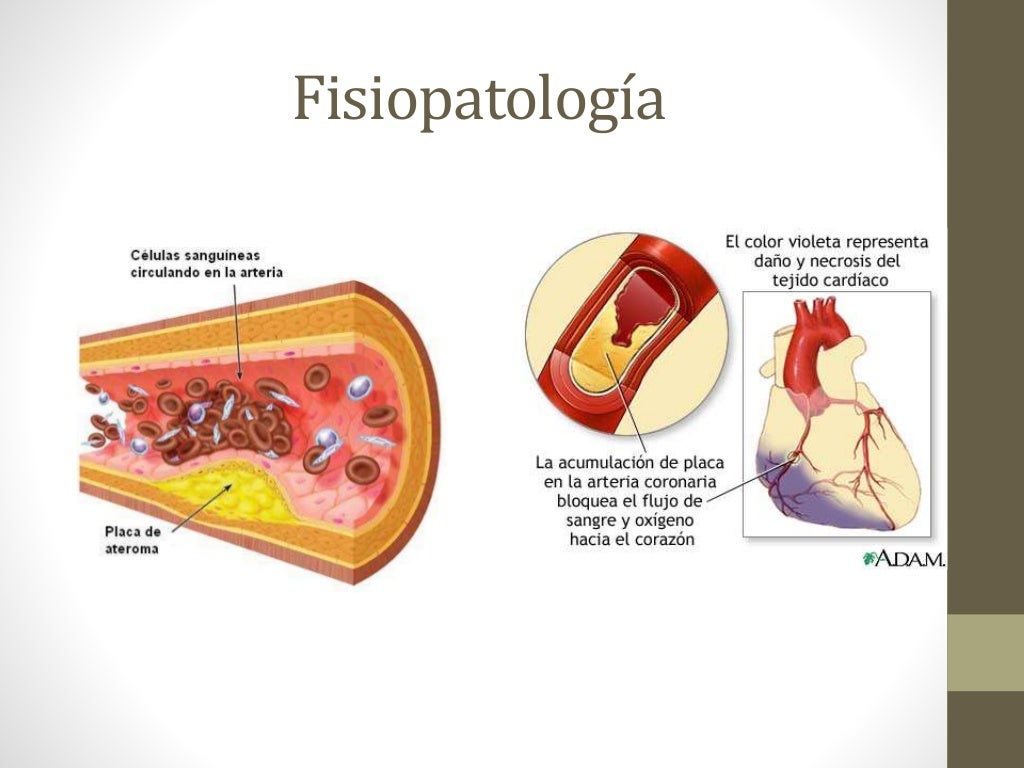 Fisiopatologia Del Infarto Agudo De Miocardio Anatomia Aterosclerosis ...