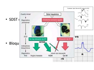 • SDST con o sin onda Q patológica
• Bloqueo rama izquierda
 