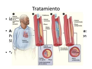Tratamiento
• Ídem IAM sin SDST + ACP o fibrinolíticos
• Angioplastía coronaria percutánea:
Procedimiento de elección en pacientes con
SDST de menos de 12 horas de evolución
• *ACP de rescate.
 