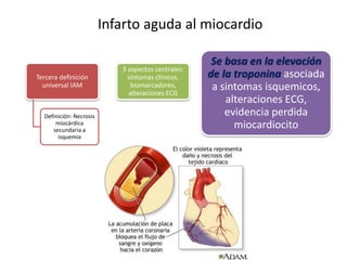 Tercera definición
universal IAM
Definición: Necrosis
miocárdica
secundaria a
isquemia
3 aspectos centrales:
síntomas clínicos,
biomarcadores,
alteraciones ECG
Se basa en la elevación
de la troponina asociada
a sintomas isquemicos,
alteraciones ECG,
evidencia perdida
miocardiocito
Infarto aguda al miocardio
 