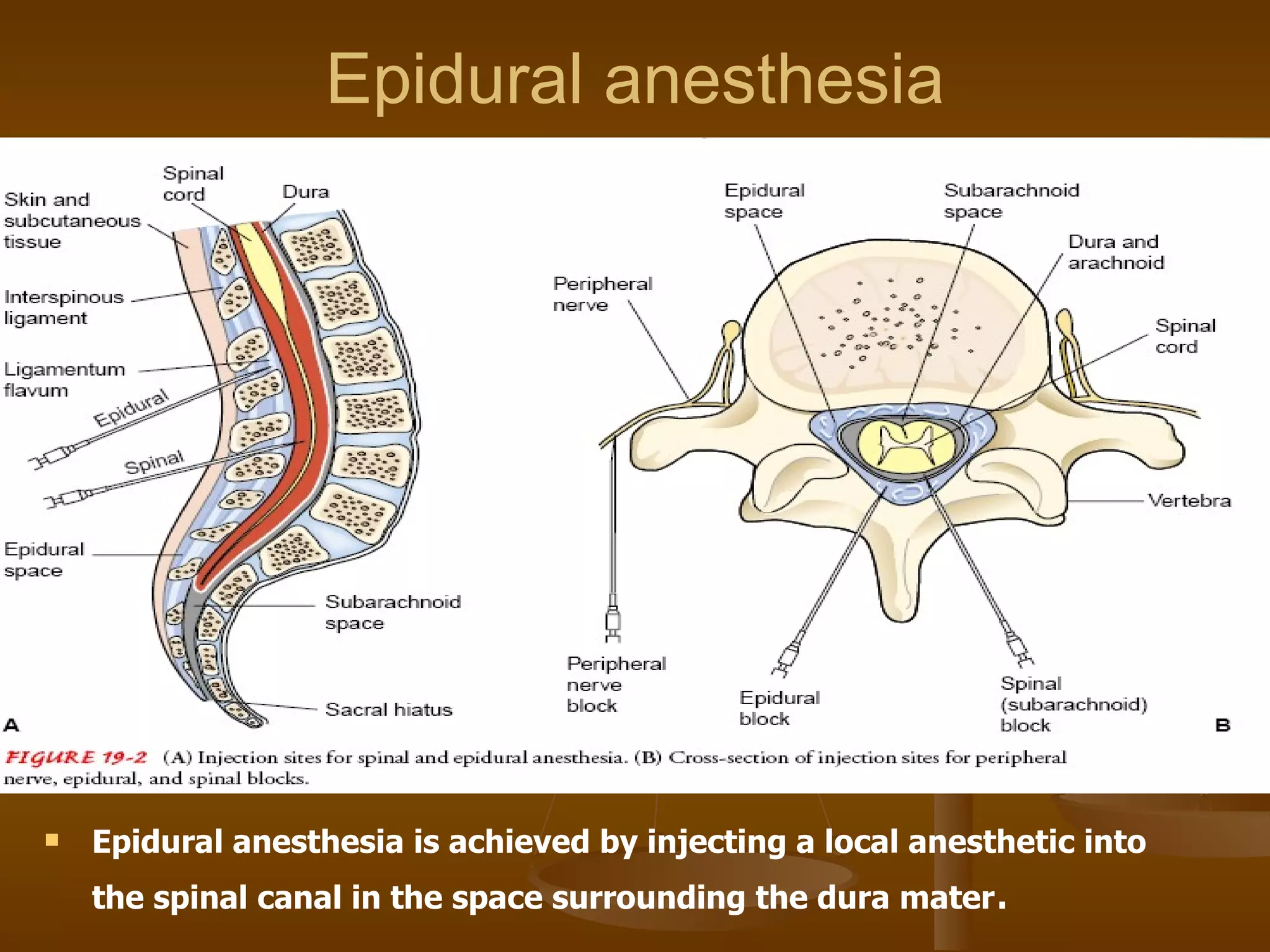Epidural anesthesia Epidural anesthesia is achieved by injecting a local anesthetic into the spinal canal in the space surrounding the dura mater . 