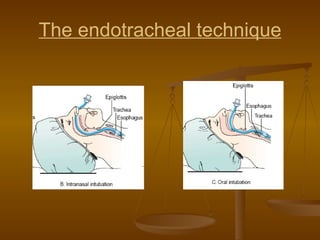 The endotracheal technique 