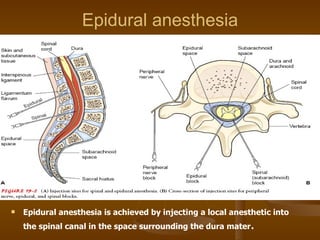 Epidural anesthesia Epidural anesthesia is achieved by injecting a local anesthetic into the spinal canal in the space surrounding the dura mater . 