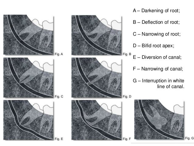 inferior alveolar nerve in opg
