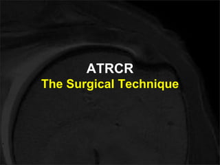 ATRCR 
The Surgical Technique 
 