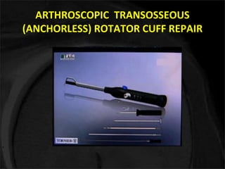 ARTHROSCOPIC TRANSOSSEOUS 
(ANCHORLESS) ROTATOR CUFF REPAIR 
 